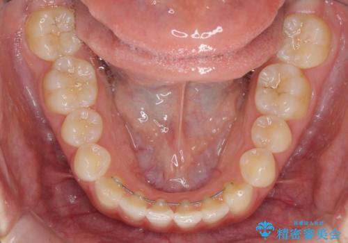 海外転居前に気になる前歯を整えたい 上下前歯の部分矯正の治療後