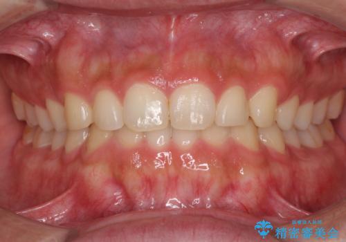 インビザラインによる、すきっ歯の改善の症例 治療後