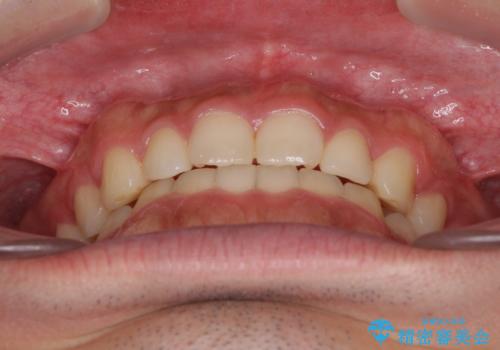 インビザラインによる、すきっ歯の改善の治療後