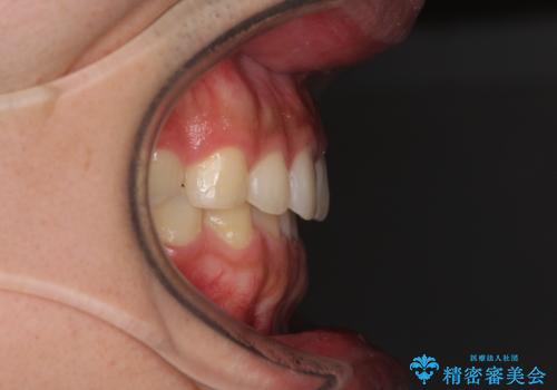 インビザラインによる、すきっ歯の改善の治療後