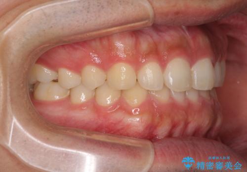 インビザラインによる、すきっ歯の改善の治療後