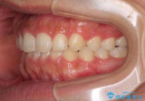 インビザラインによる、すきっ歯の改善の治療後