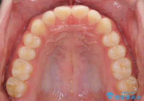 インビザラインによる、すきっ歯の改善の治療後