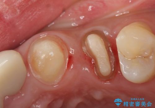 オールセラミッククラウン　歯牙の挺出後の補綴の治療中