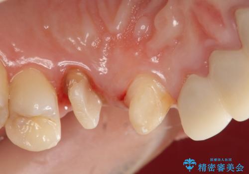 オールセラミッククラウン 歯牙の挺出後の補綴の治療中