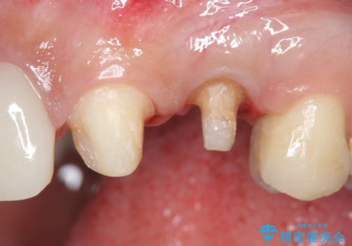 オールセラミッククラウン 歯牙の挺出後の補綴の治療中