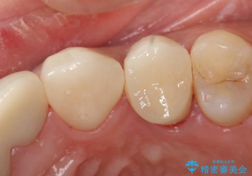 オールセラミッククラウン 歯牙の挺出後の補綴の症例 治療後