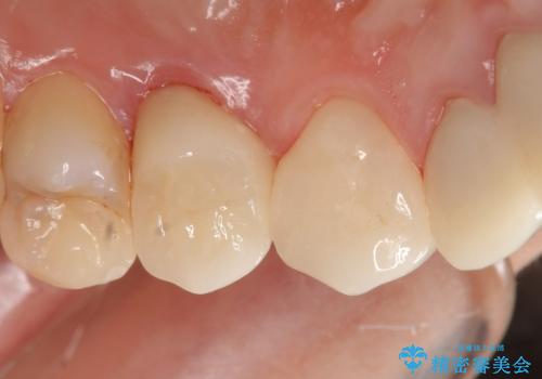 オールセラミッククラウン 歯牙の挺出後の補綴の治療後
