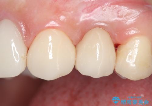 オールセラミッククラウン 歯牙の挺出後の補綴の治療後