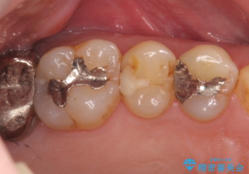 精密なむし歯の治療　ゴールドインレーの治療前