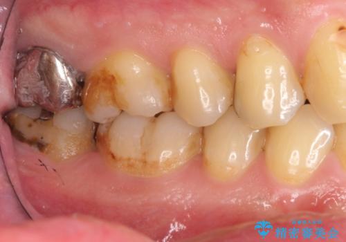 精密なむし歯の治療　ゴールドインレーの治療前