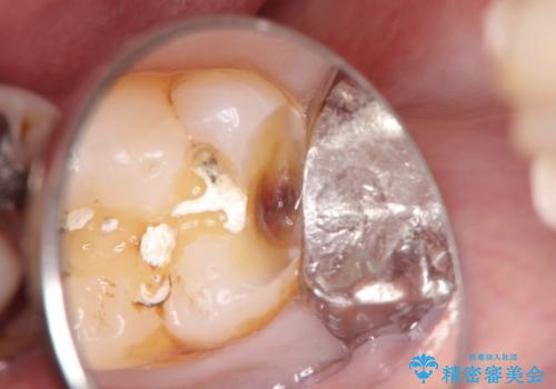 精密なむし歯の治療 ゴールドインレーの治療前
