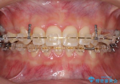 前歯のすきま 右上の小臼歯の垂直的骨吸収を抜歯で解決の治療中