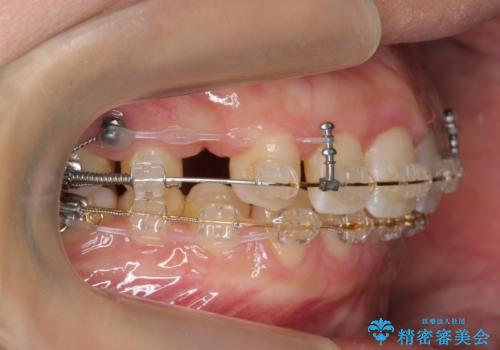 前歯のすきま 右上の小臼歯の垂直的骨吸収を抜歯で解決の治療中