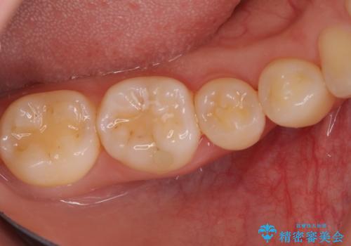 このままでは抜歯と言われた 失われた骨の再生治療 の治療後