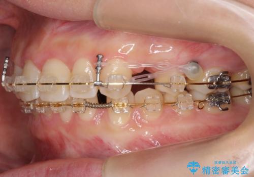 前歯のすきま 右上の小臼歯の垂直的骨吸収を抜歯で解決の治療中