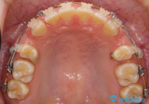 前歯のすきま　右上の小臼歯の垂直的骨吸収を抜歯で解決の治療中