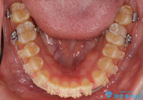 前歯のすきま 右上の小臼歯の垂直的骨吸収を抜歯で解決の治療中