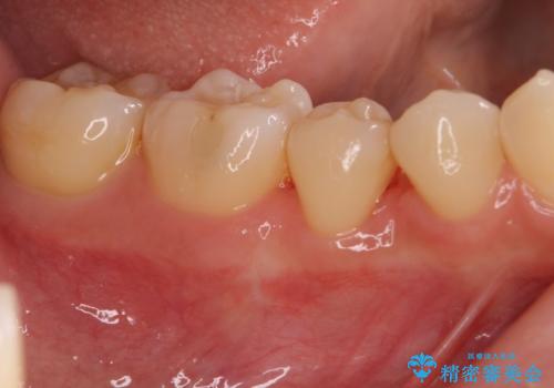 このままでは抜歯と言われた 失われた骨の再生治療 の治療後
