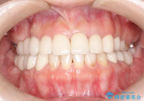 セラミックと矯正を併用してきれいな前歯への治療後