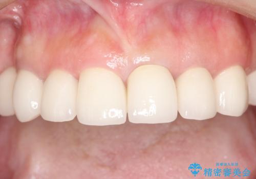 セラミックと矯正を併用してきれいな前歯への治療後