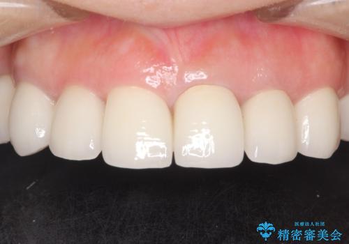 セラミックと矯正を併用してきれいな前歯への治療後