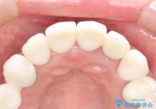 セラミックと矯正を併用してきれいな前歯への治療後