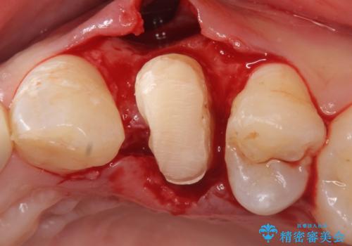 オールセラミッククラウン 歯牙の挺出後の補綴の治療中