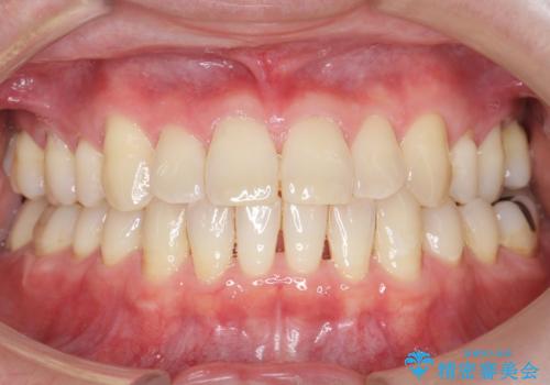 奥歯に違和感がある 30代男性の治療後