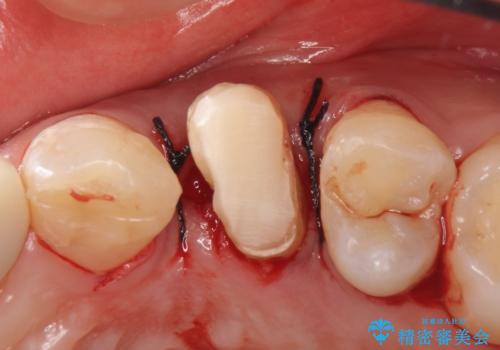 オールセラミッククラウン 歯牙の挺出後の補綴の治療後