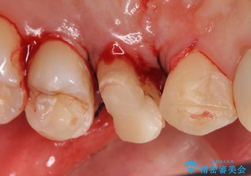 オールセラミッククラウン 歯牙の挺出後の補綴の治療後
