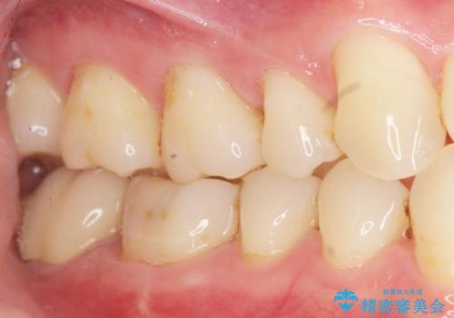 奥歯に違和感がある 30代男性の治療後