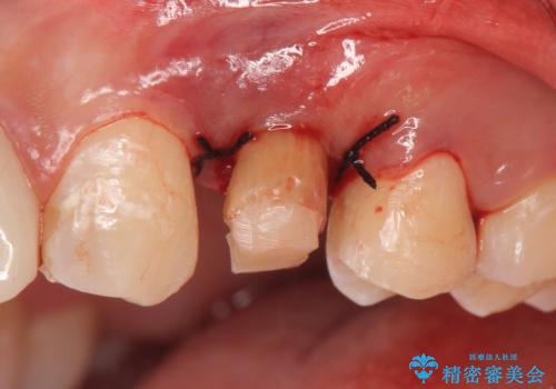 オールセラミッククラウン　歯牙の挺出後の補綴の治療後