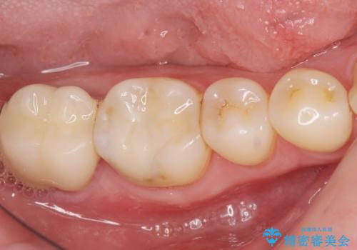 奥歯に違和感がある 30代男性の症例 治療後