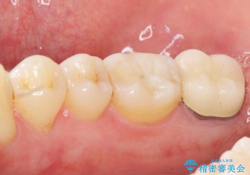 奥歯に違和感がある 30代男性の治療後