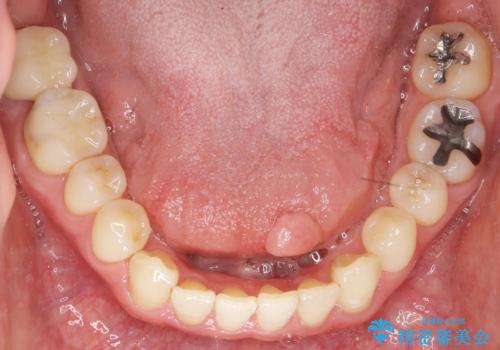 奥歯に違和感がある 30代男性の治療後