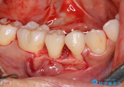 このままでは抜歯と言われた 失われた骨の再生治療 の治療中