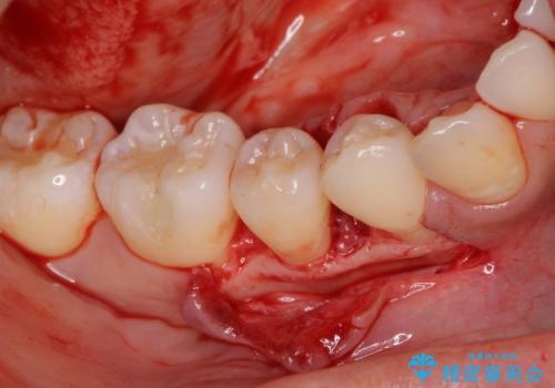 このままでは抜歯と言われた 失われた骨の再生治療 の治療後