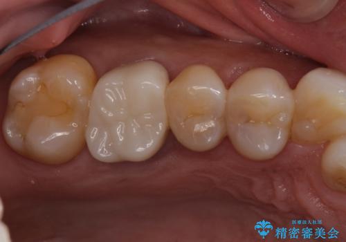 体調が悪いと腫れる 根管治療とセラミック治療の治療後