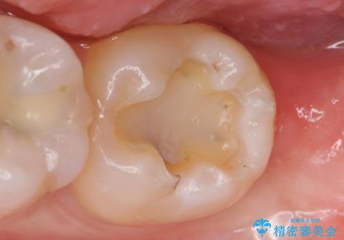 セラミックインレー 古い銀歯の治療の治療中