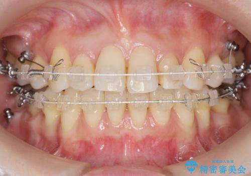 前歯で引っ込んでいる歯がある 他院で矯正200万と言われたの治療中