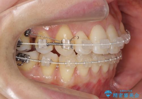 前歯で引っ込んでいる歯がある 他院で矯正200万と言われたの治療中