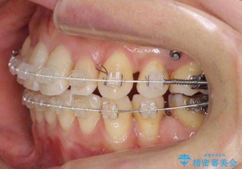 前歯で引っ込んでいる歯がある 他院で矯正200万と言われたの治療中