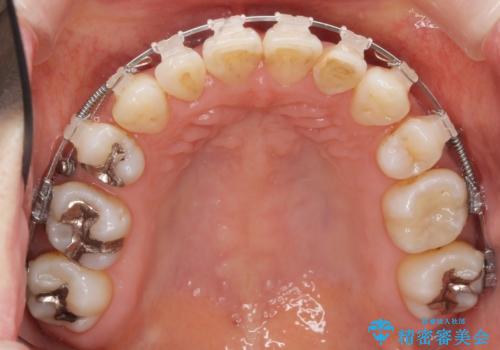 前歯で引っ込んでいる歯がある 他院で矯正200万と言われたの治療中