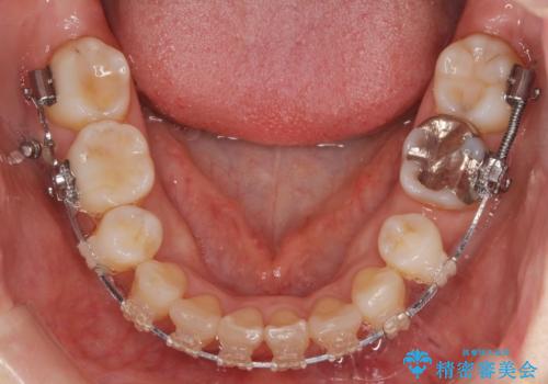 前歯で引っ込んでいる歯がある 他院で矯正200万と言われたの治療中