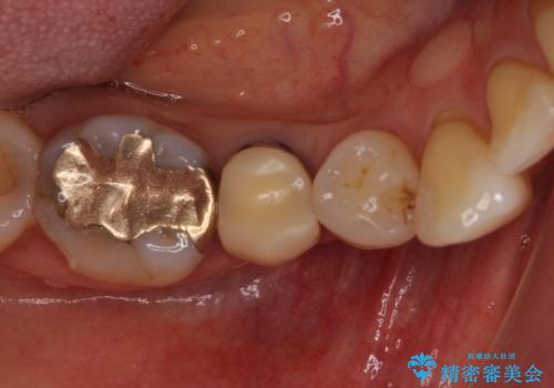歯に穴があいた　奥歯のセラミック治療の症例 治療前
