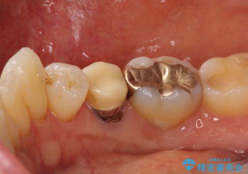 歯に穴があいた 奥歯のセラミック治療の治療前