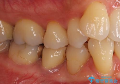 歯に穴があいた 奥歯のセラミック治療の治療前