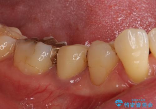歯に穴があいた 奥歯のセラミック治療の治療前