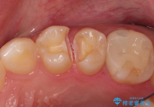 精密なむし歯の治療 セラミックインレーの治療中